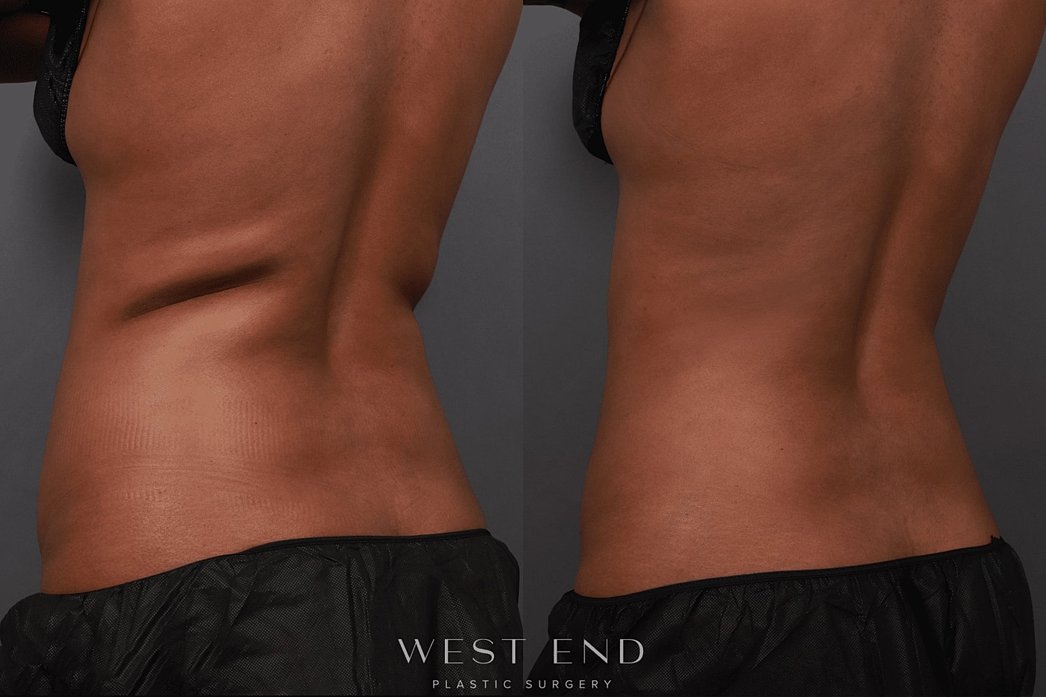 Before and After Image of Fat Freezing Treatment Washington DC