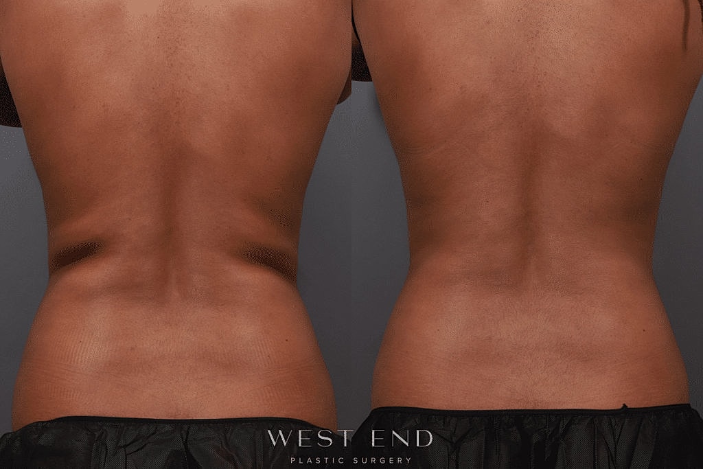 Before and After Image of Fat Freezing Treatment Washington DC