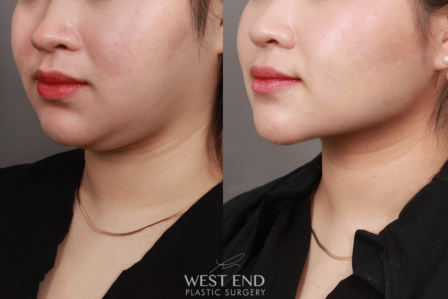 Before and after facial sculpting results.
