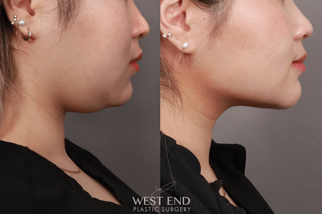 Before and after profile view of facial surgery.