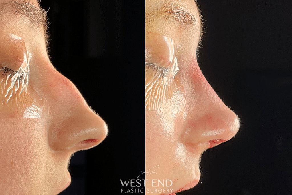 Before and after nasal surgery comparison image.