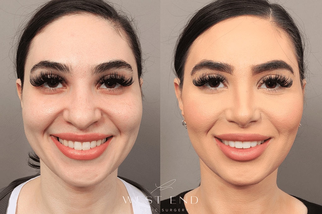 Before and after facial cosmetic enhancement comparison.