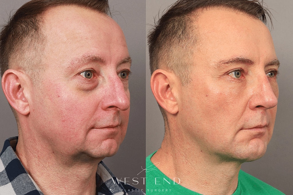 Before and after plastic surgery transformation.