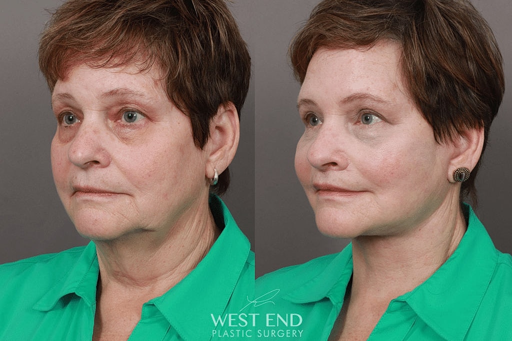 Before and after profile of a woman's face
