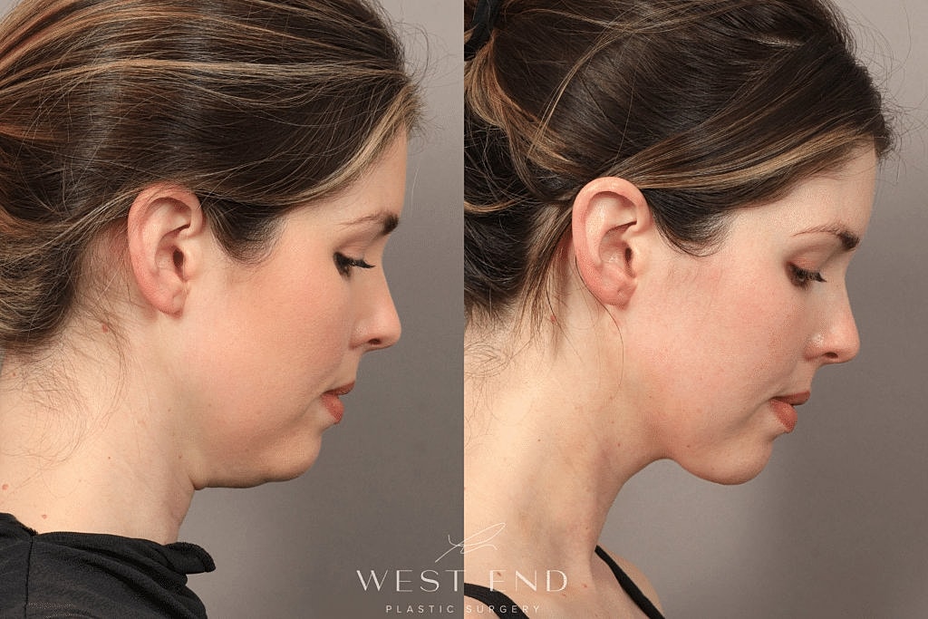 Before and after profile comparison of jawline.