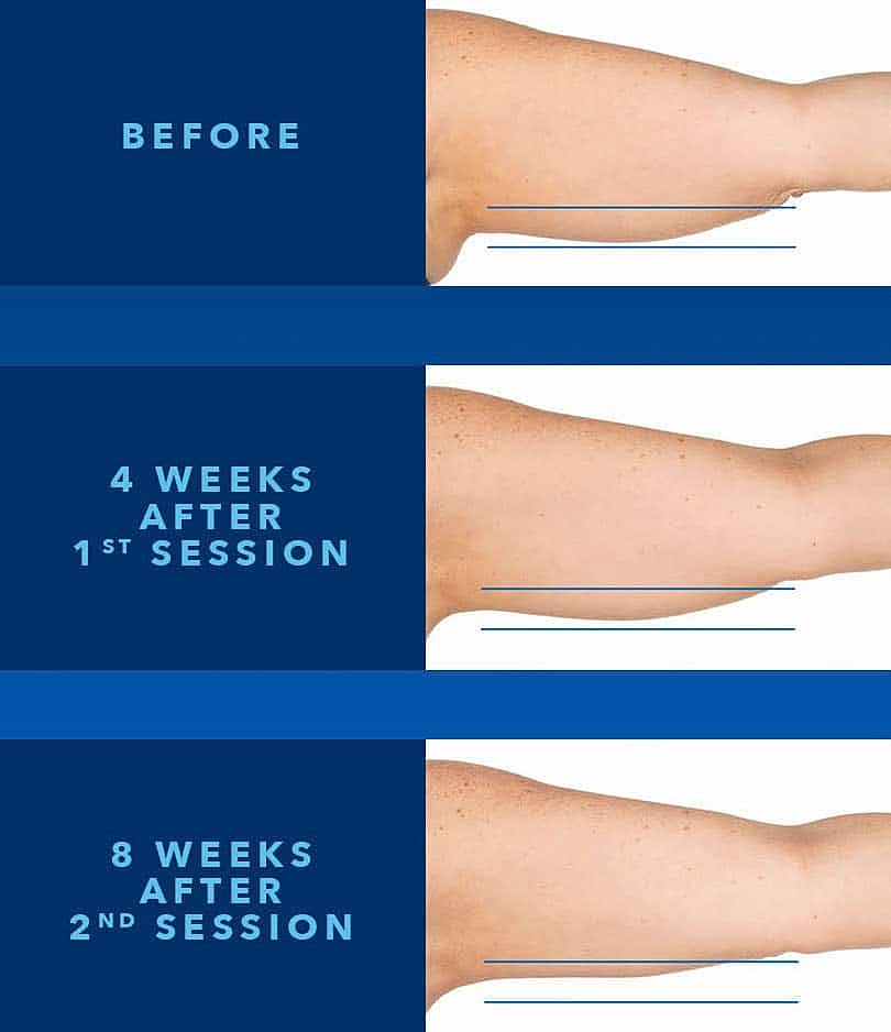 Before and after arm treatment results over time