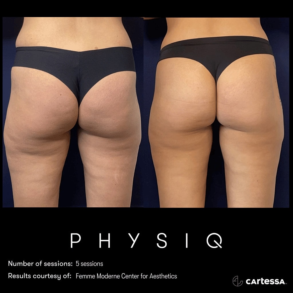 rear end of female before and after physiq body contouring
