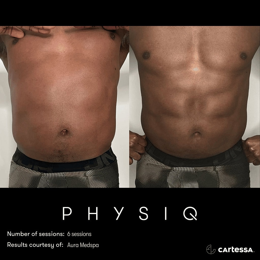 physiq body sculpting contouring before and after photo 1 west end plastic surgery