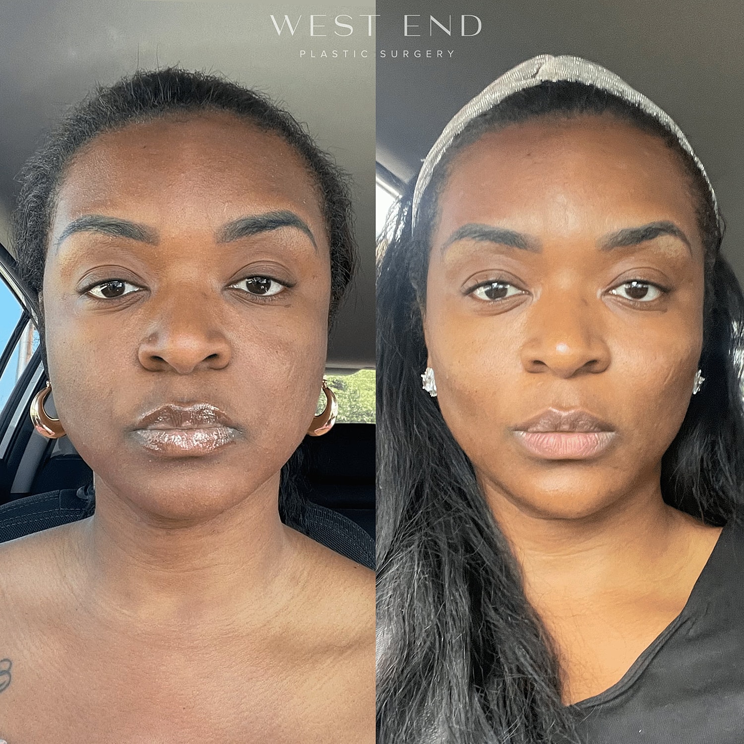 Before and After Image of Restylane® Refyne and Defyne Washington DC