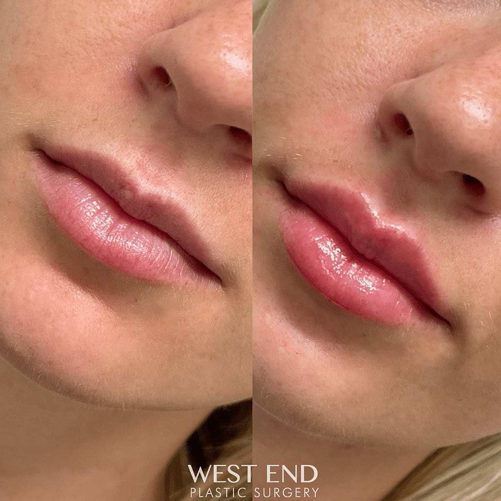 Before and after lip enhancement photos.