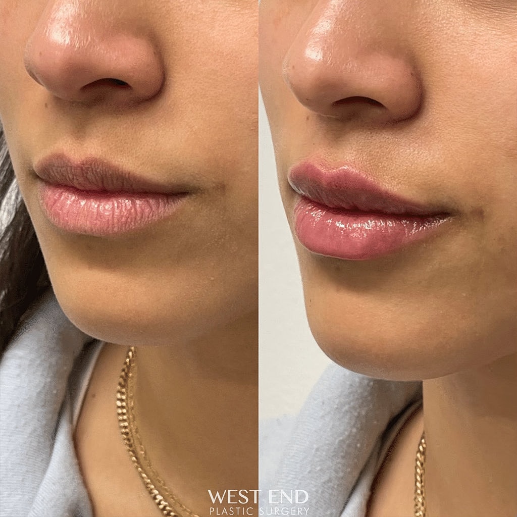 Before and after lip enhancement results.