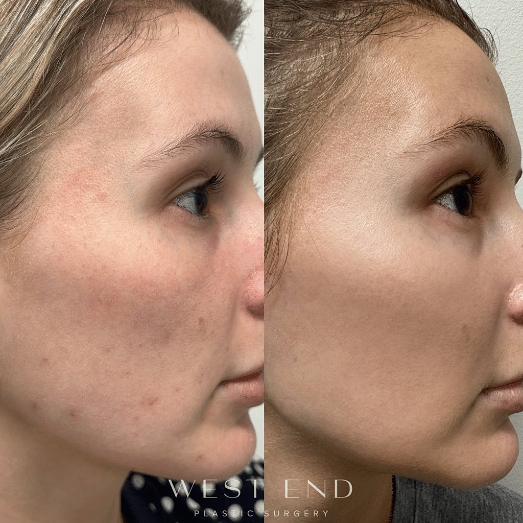 Before and after skin treatment comparison photo.