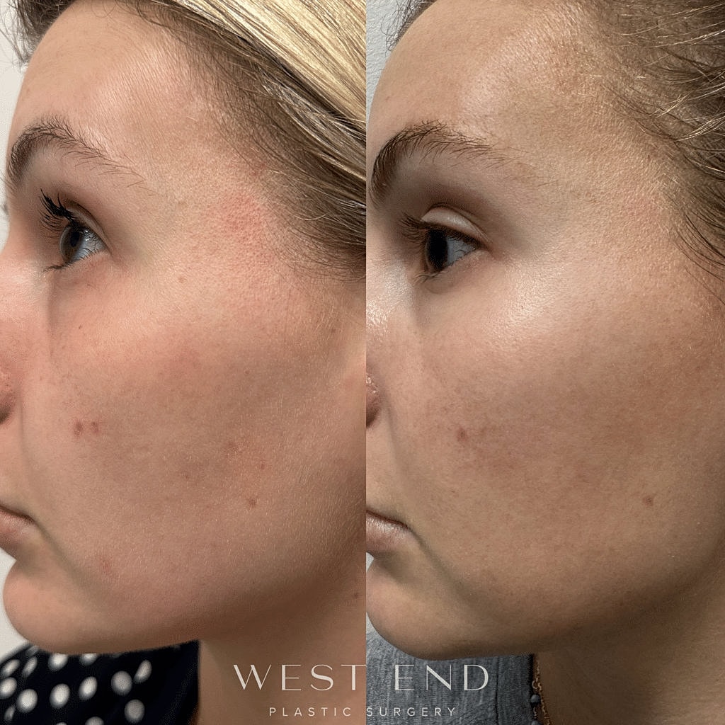 Before and After Image of Laser Genesis Treatment Washington DC