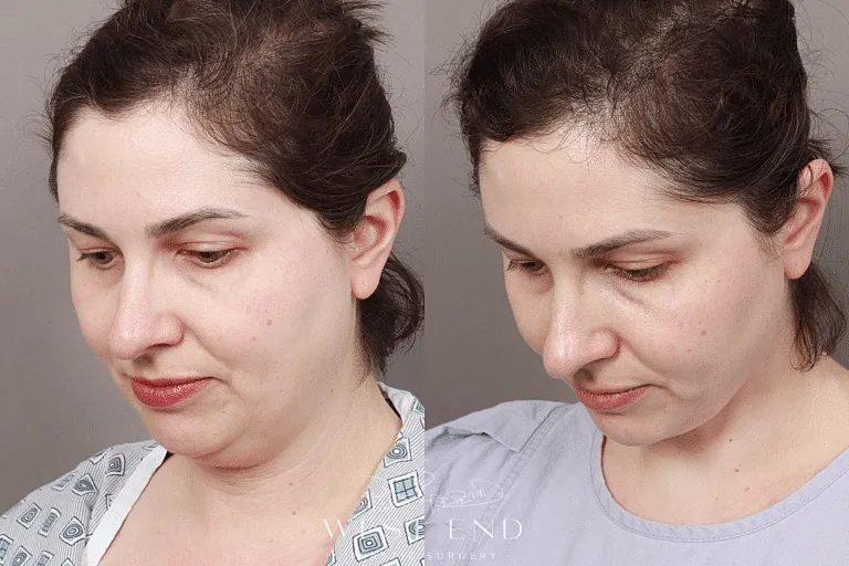 Renuvion Facial Washington DC