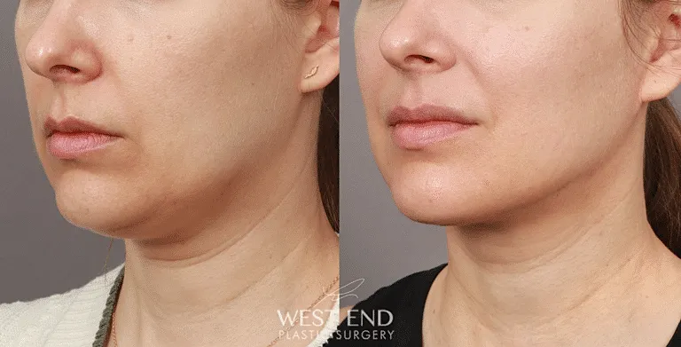 Before Image of Renuvion Facial Treatments Washington DC