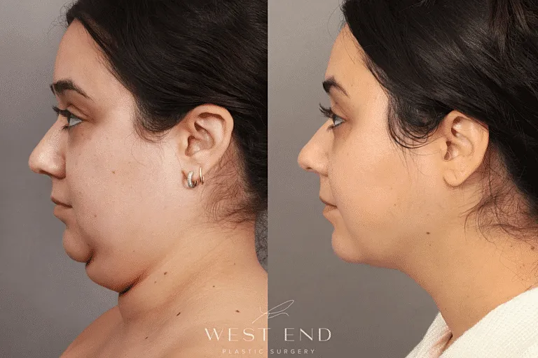 After Image of Renuvion Facial Treatments Washington DC