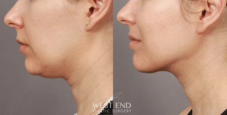 Before & After Image of Renuvion Facial Treatments Washington DC"Before & After Image of Renuvion Facial Treatments Washington DC