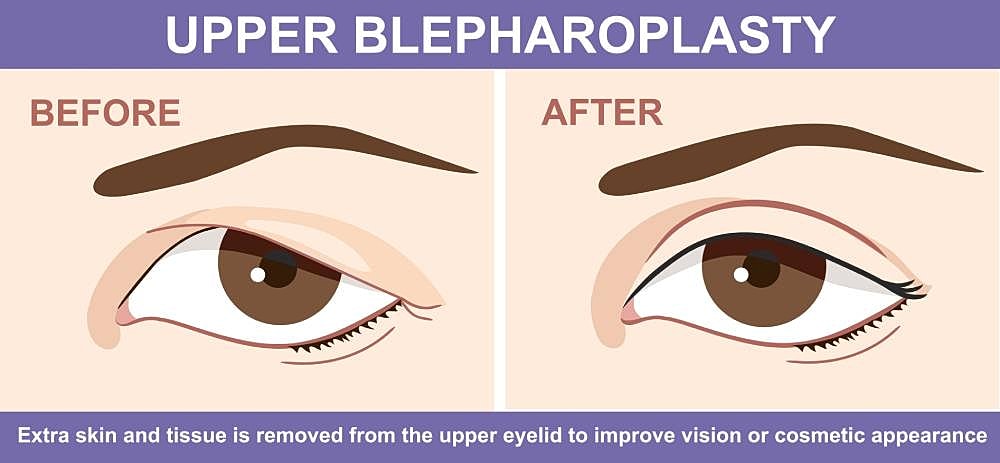 Upper blepharoplasty before and after comparison.