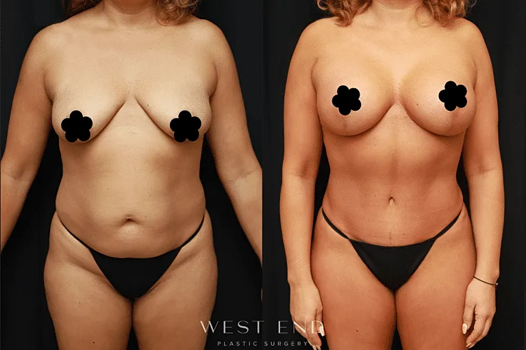 Before and after plastic surgery transformation.