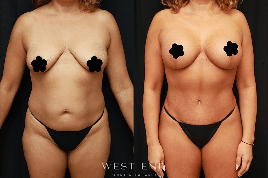Before and after cosmetic surgery transformation.