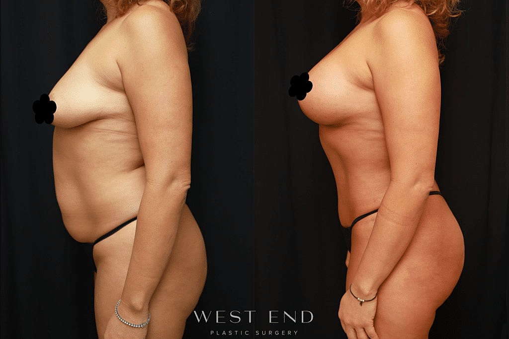 Before and after body transformation surgery comparison.