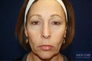 Short Scar Facelift Before | Washington D.C. Short Scar Facelift Before | Washington D.C.