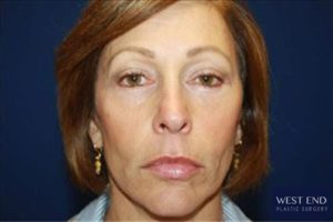 Short Scar Facelift After | Washington D.C. Short Scar Facelift After | Washington D.C.