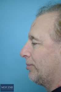 Rhinoplasty After | Washington D.C. Rhinoplasty After | Washington D.C.