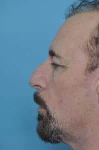 Rhinoplasty Before | Washington D.C. Rhinoplasty Before | Washington D.C.