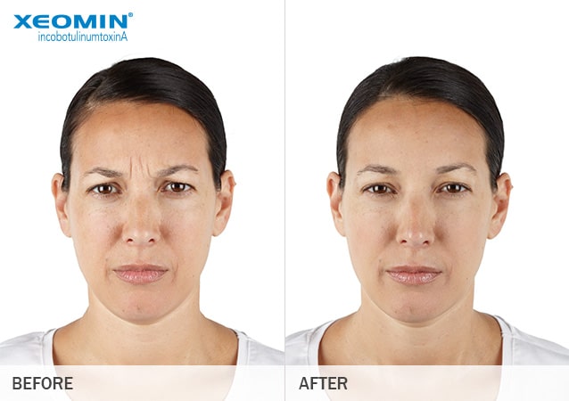 specials-xeomin-ba