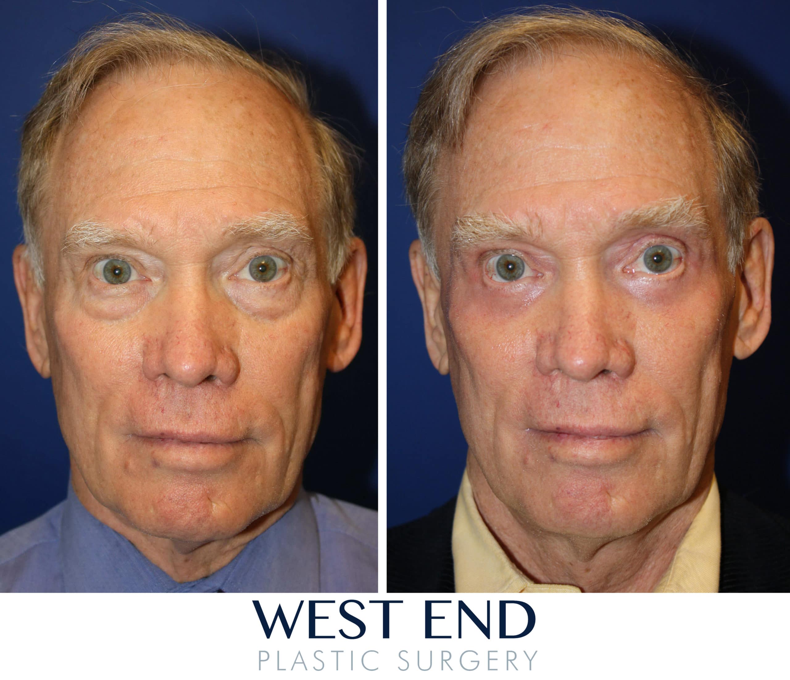 Washington, D.C. Eyelid Surgery at West End Plastic Surgery
Ectropion After Lower Blepharoplasty