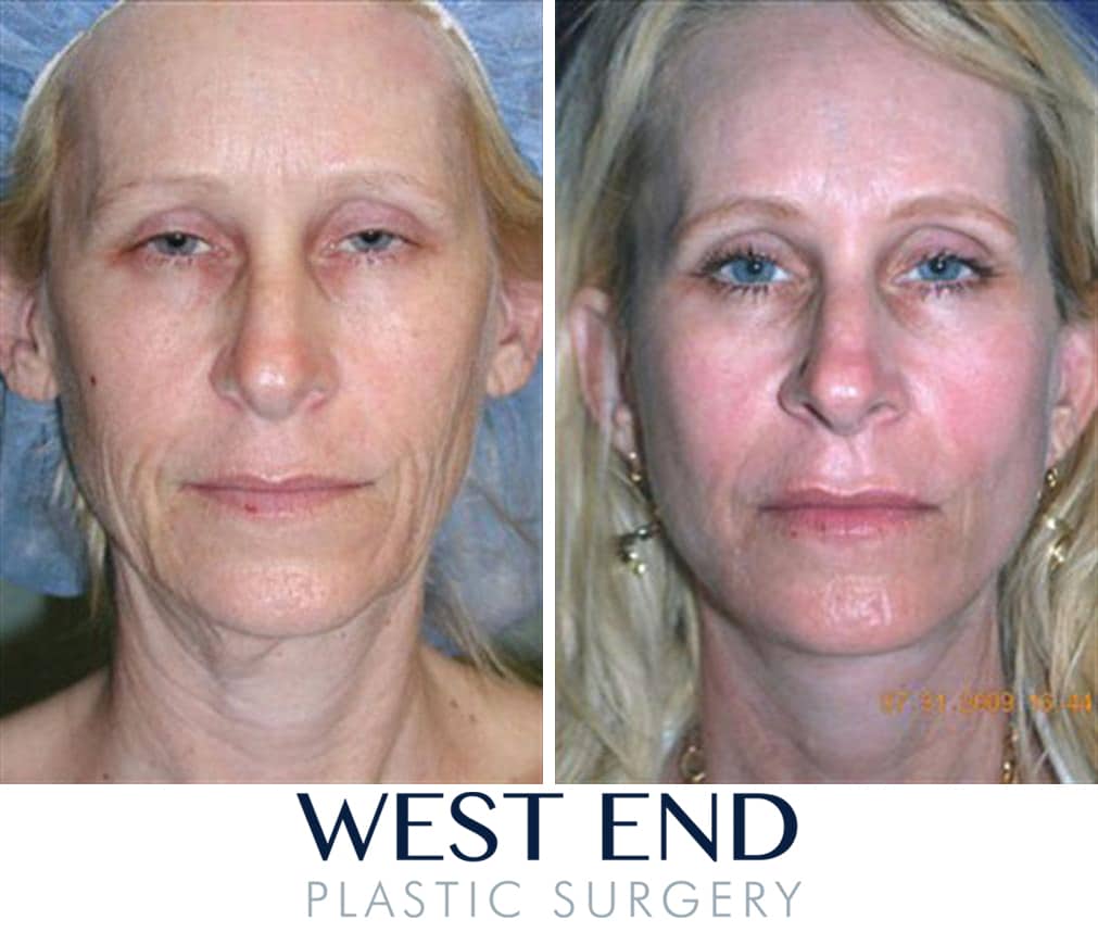 Join told facial fat implants final Facial fat implants sorry