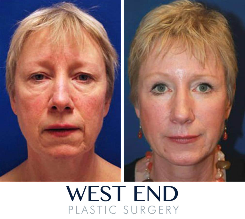 Facial fat implants you Facial fat implants not