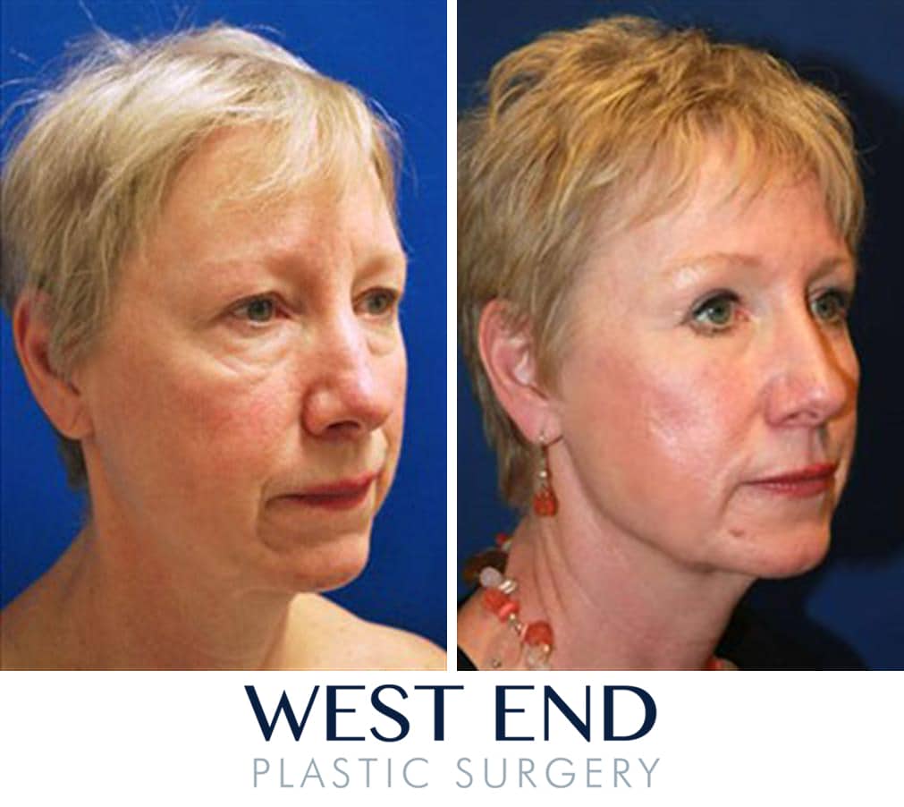 decrease facial edema post face lift Tranny massive cum