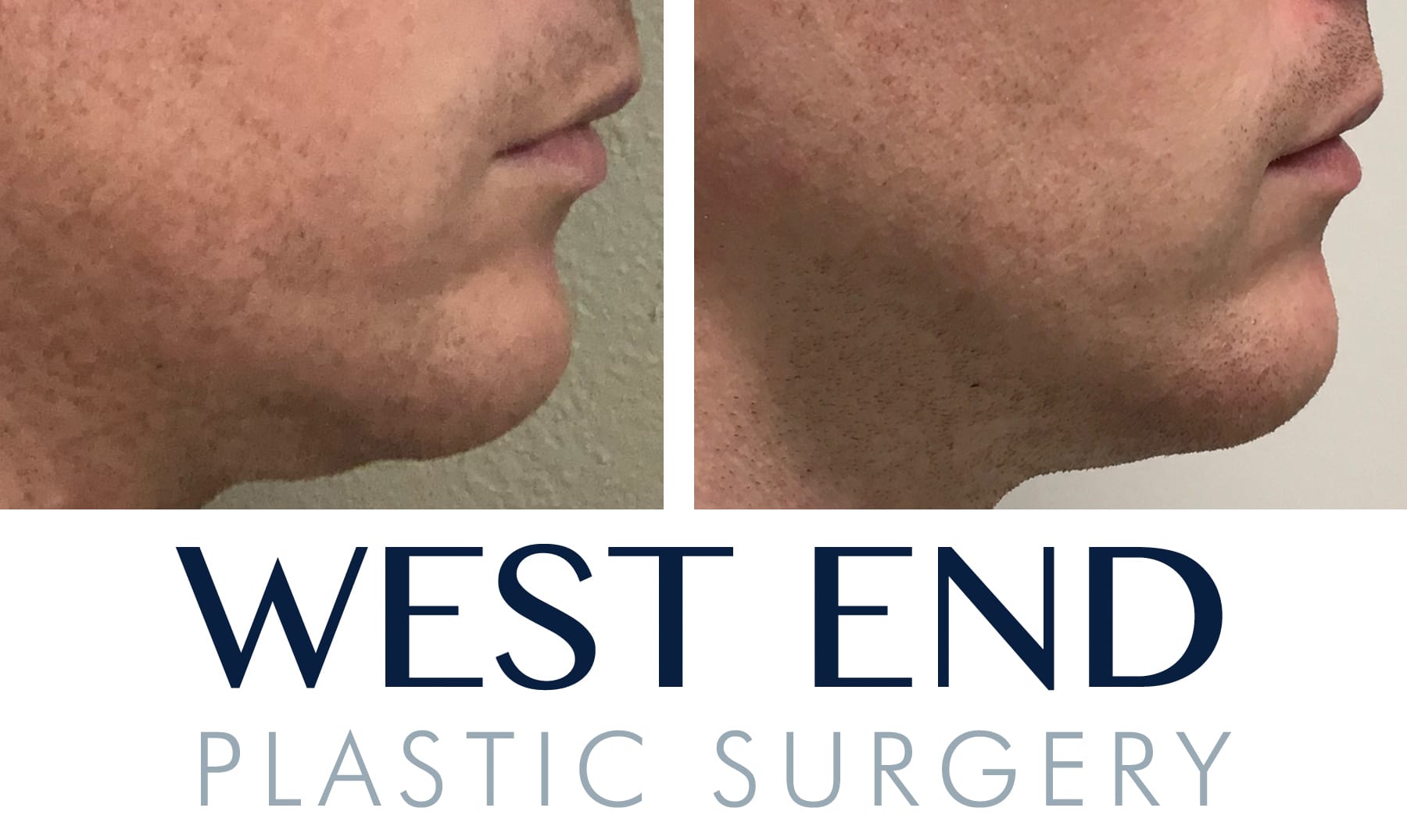146 Kybella