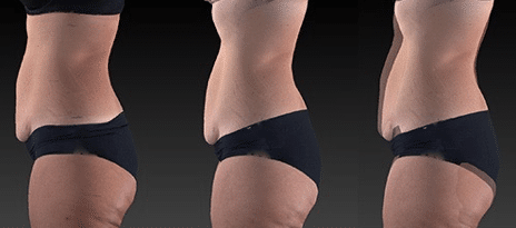 UltraSlim Before & After UltraSlim Before & After