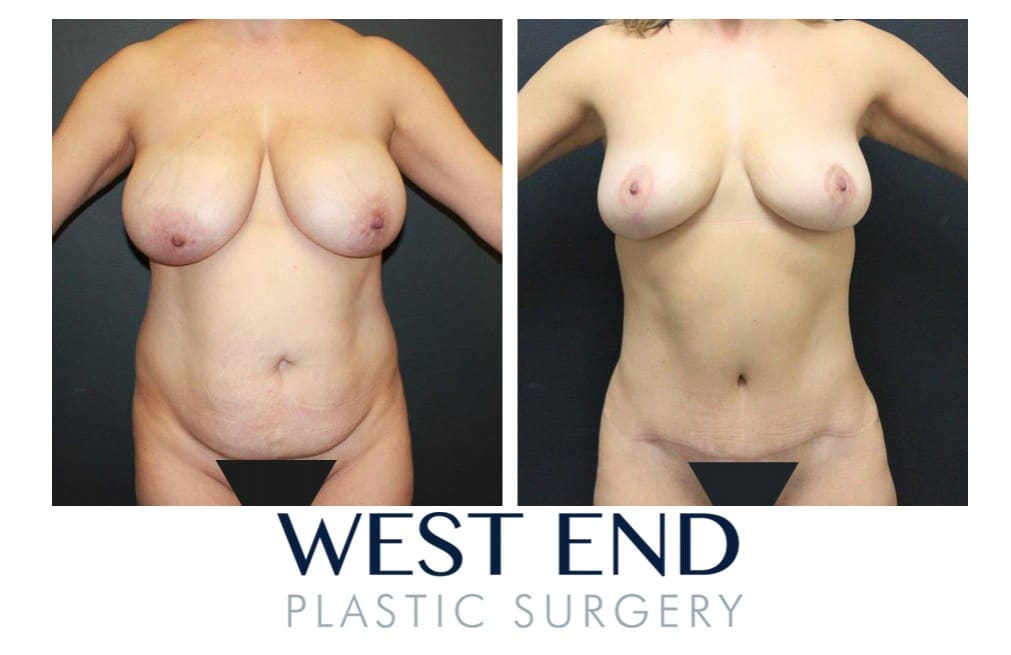 mommy makeover patient Mommy makeover patient