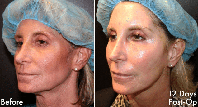 J-Plasma Renuvion Before & After J-Plasma Renuvion Before & After