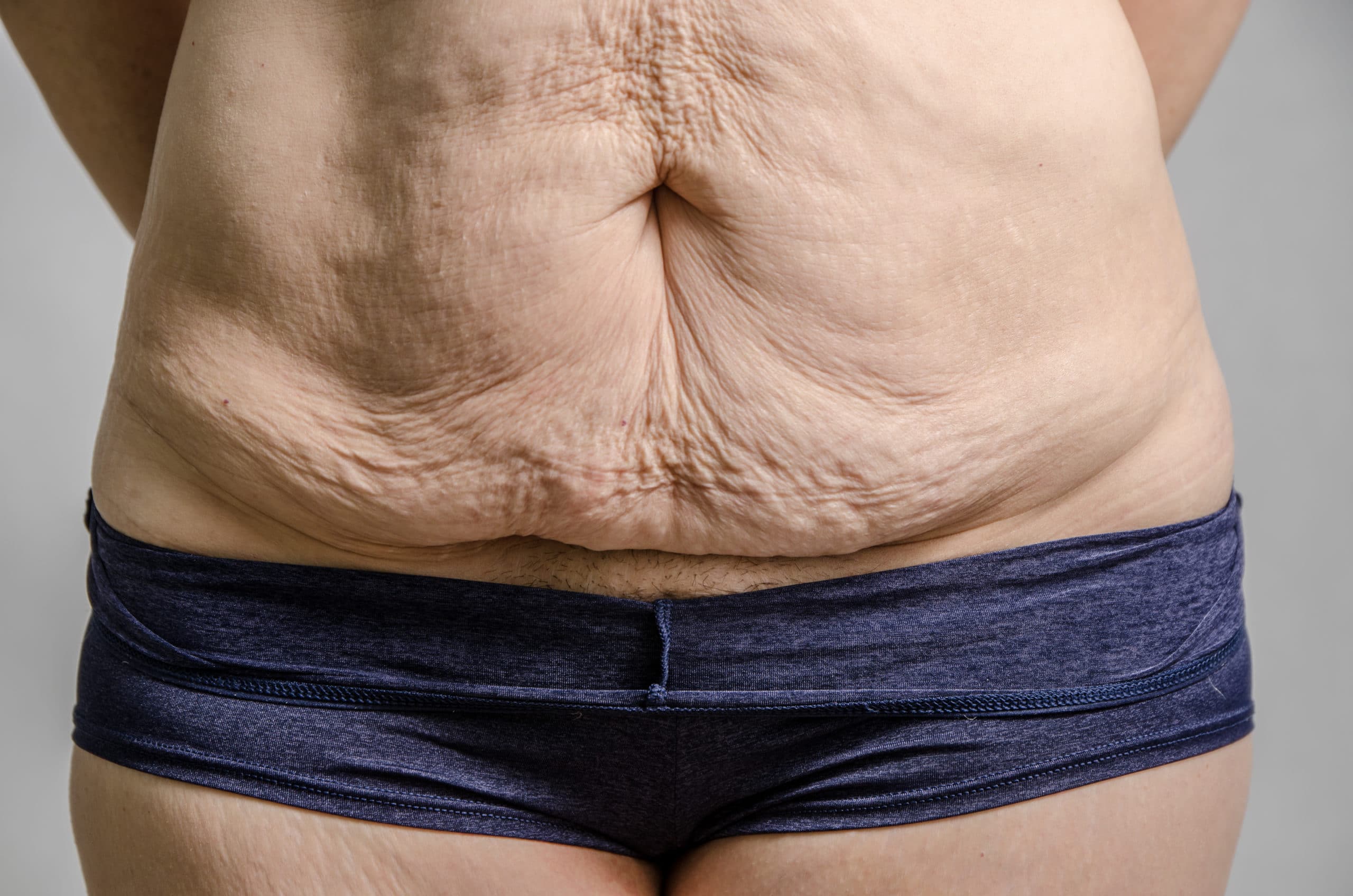 Tummy Tuck in Washington, D.C. | West End Plastic Surgery 1