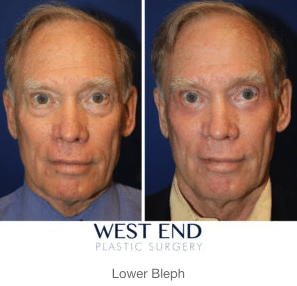 Eyelid Surgery Before & After | West End Plastic Surgery Eyelid Surgery Before & After | West End Plastic Surgery