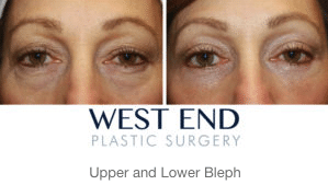 Eyelid Surgery Before & After 3 | West End Plastic Surgery Eyelid Surgery Before & After 3 | West End Plastic Surgery