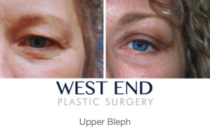 Eyelid Surgery Before & After 4 | West End Plastic Surgery Eyelid Surgery Before & After 4 | West End Plastic Surgery