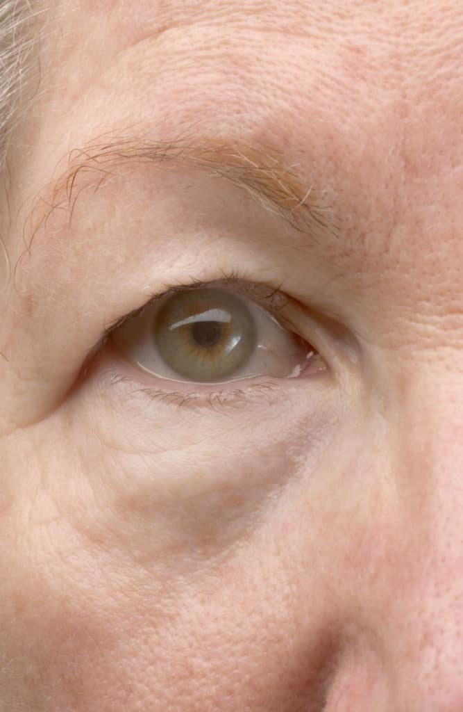 img-responsive Eyelid Surgery | West End Plastic Surgery