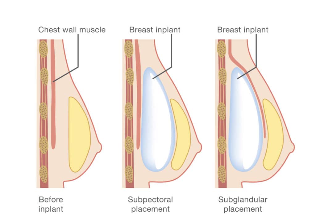 Diagram about method of insertion for breast implant. Cosmetic surgery illustration.