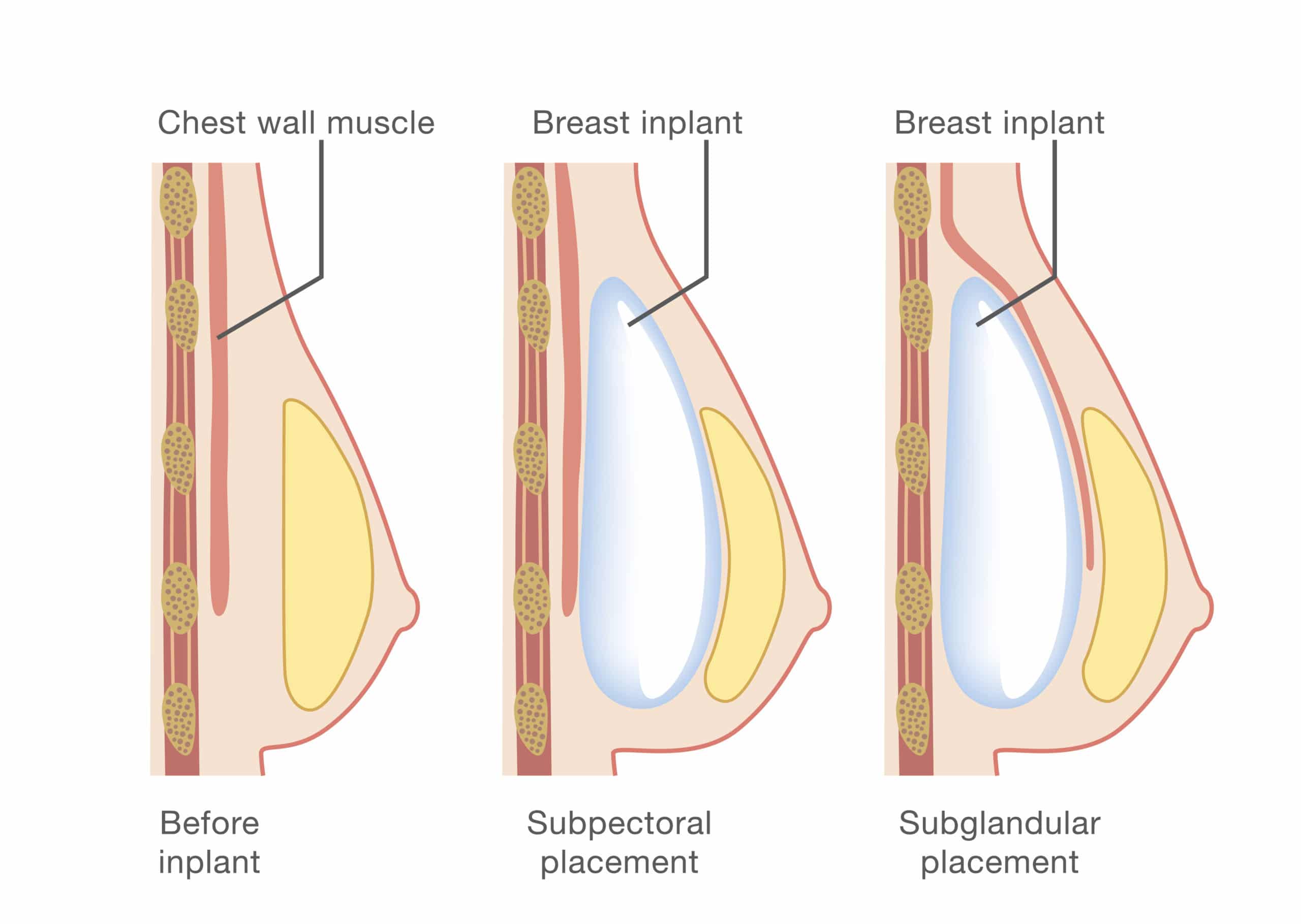 Breast Augmentation Revision Procedure Washington DC