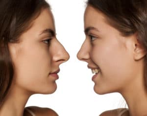 comparative portrait of the same woman, before and after rhinoplasty