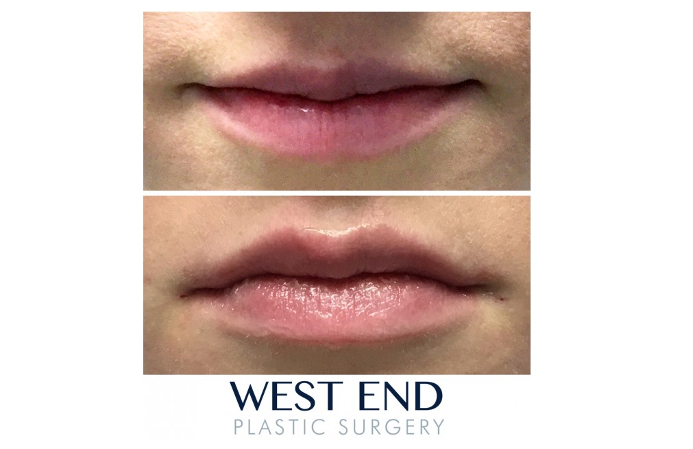 Juvederm Filler Washington D.C. Juvederm Filler Washington D.C.