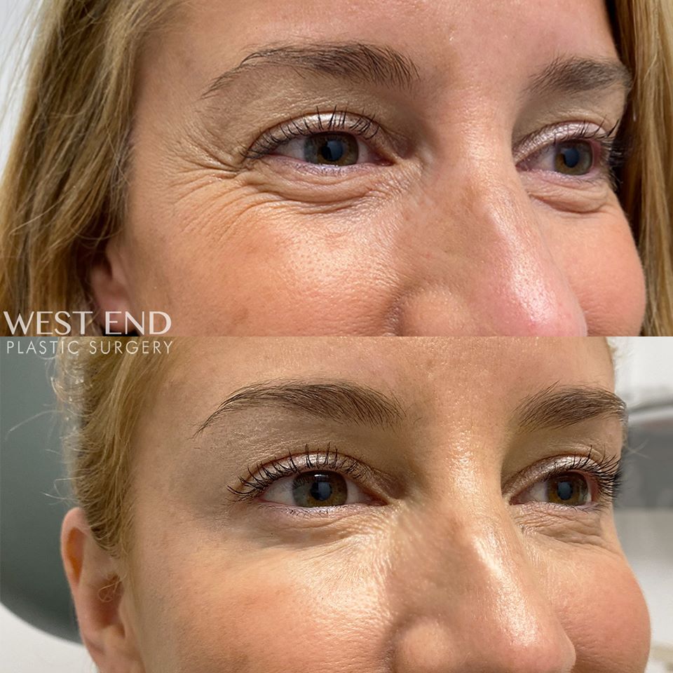 Before and After Image of XEOMIN® Washington DC