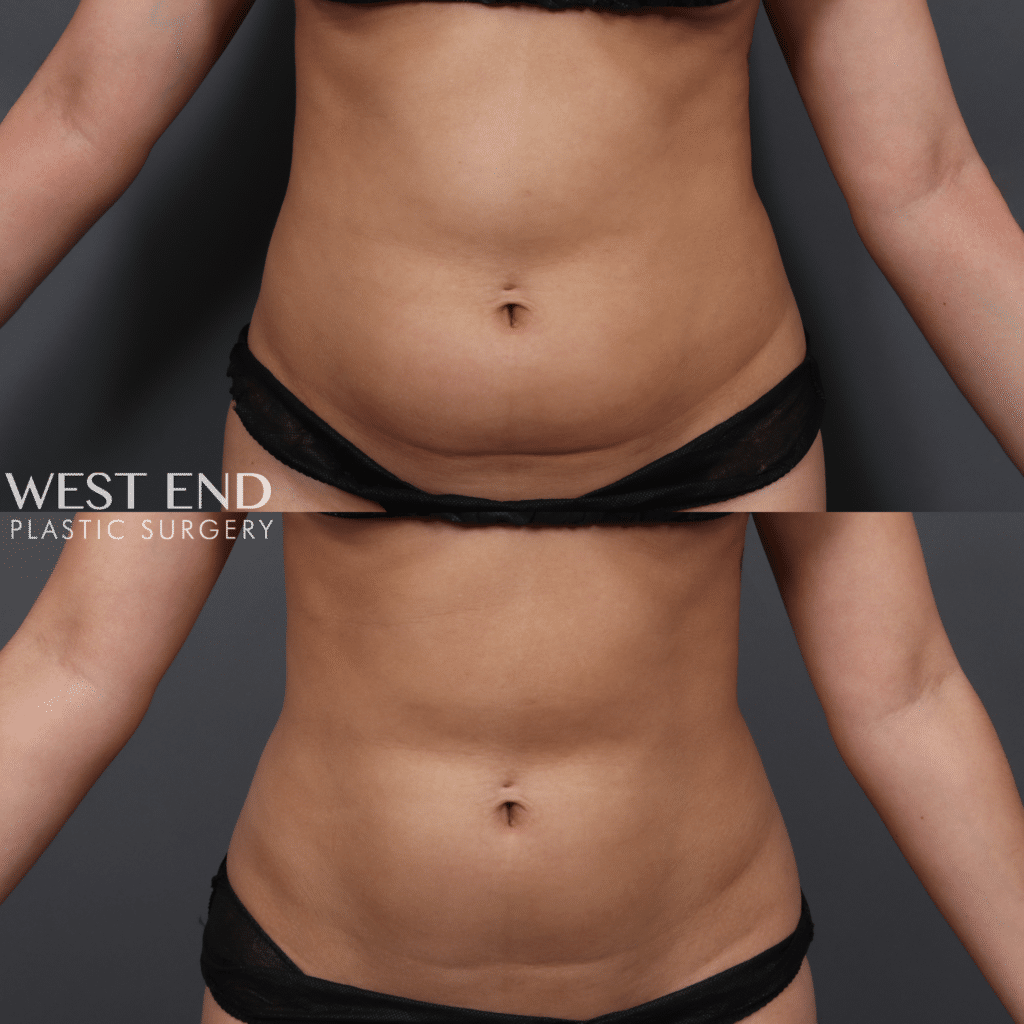 coolsculpting