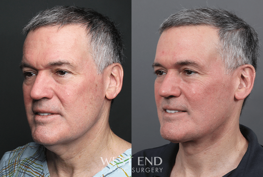 right angle West End Plastic Surgery